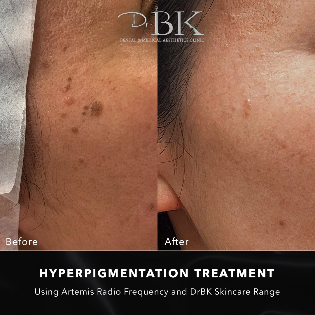 Radio frequency microneedling at DrBK