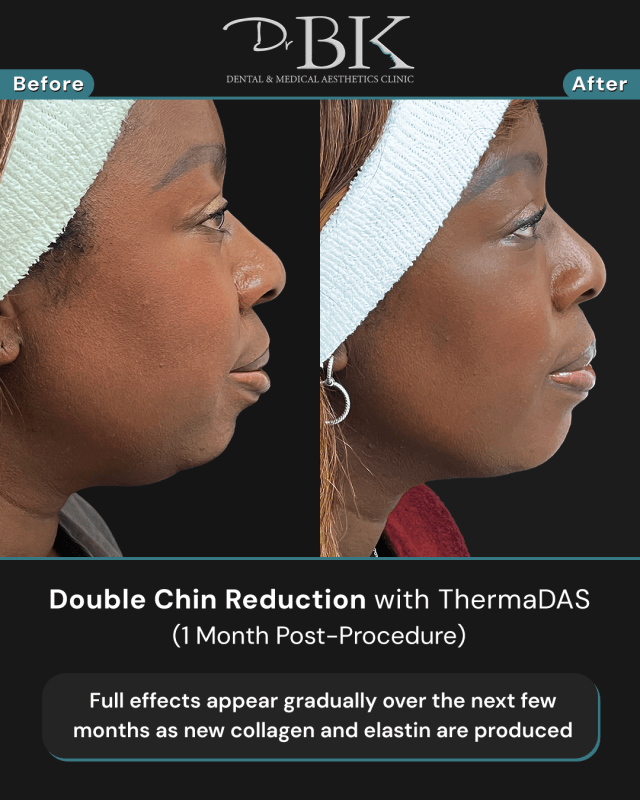 Before and after image of thermadas treatment. 1 month post-treatment.
