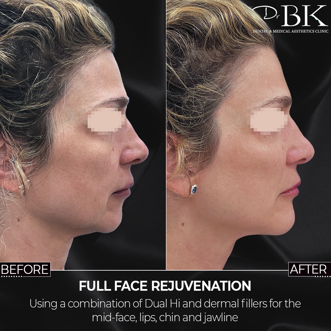 Before and After Dual Hi (HiFU) Before and After Dual Hi (HiFU)