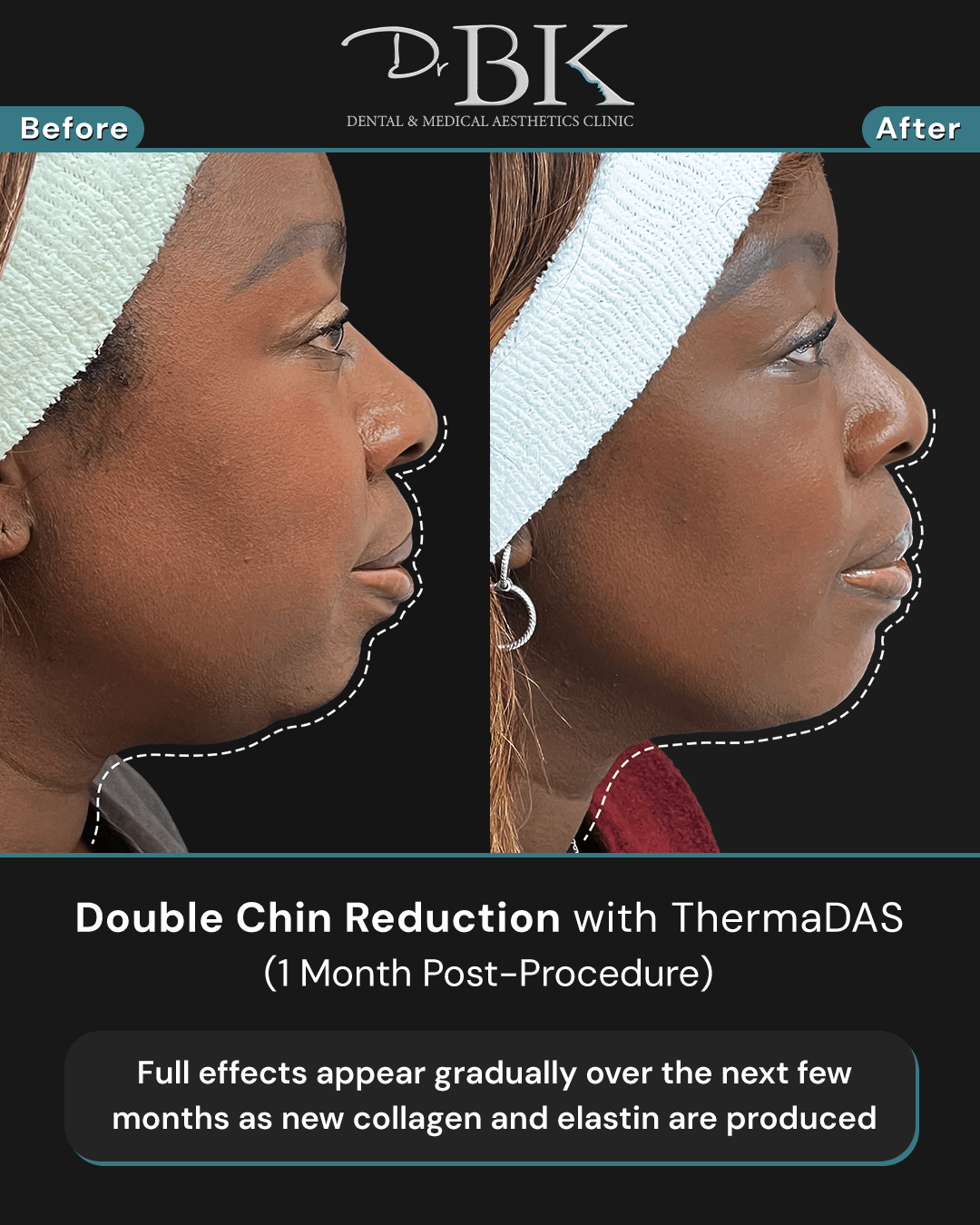 Before and after image of thermadas treatment. 1 month post-treatment.