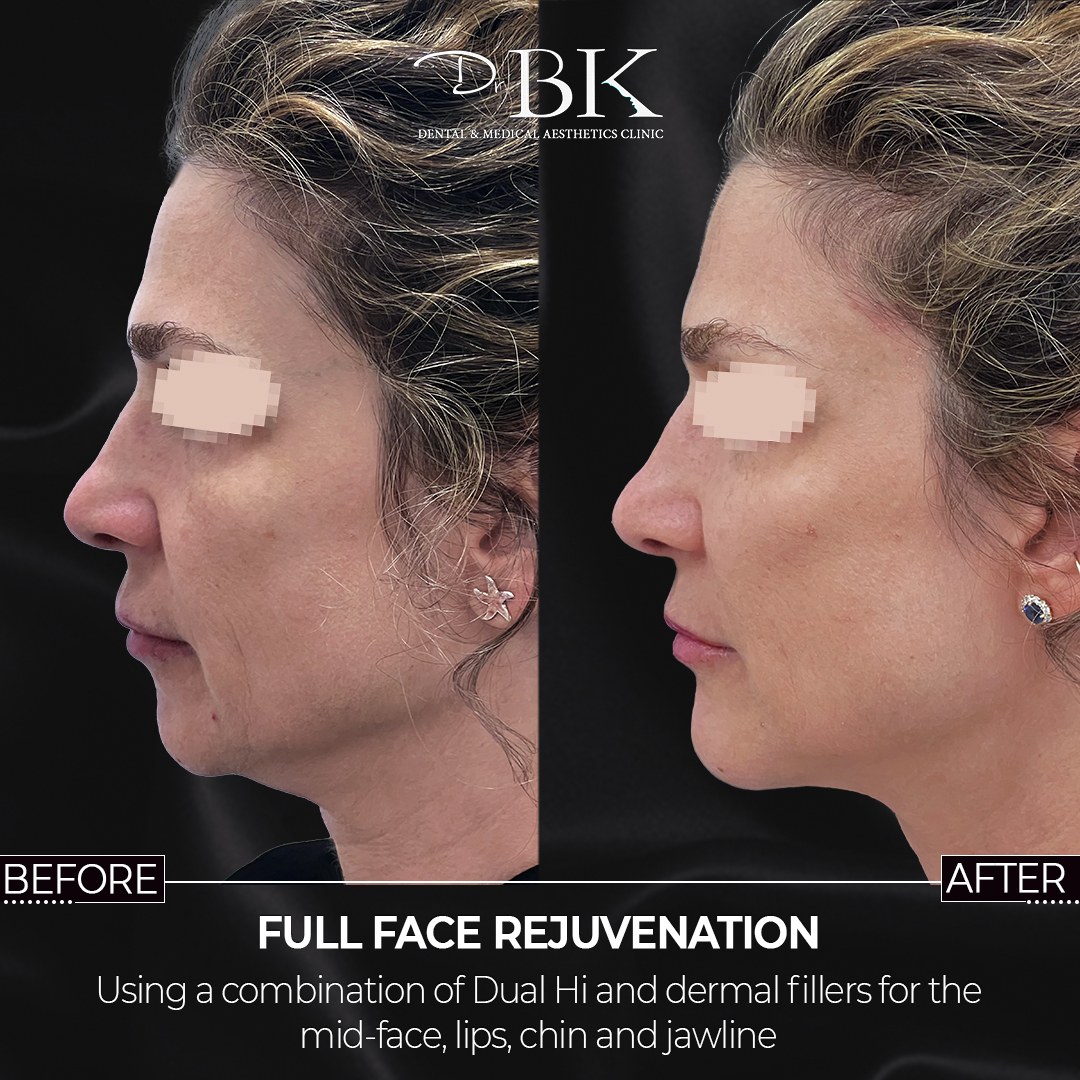 Before and After Dual Hi (HiFU) Before and After Dual Hi (HiFU)