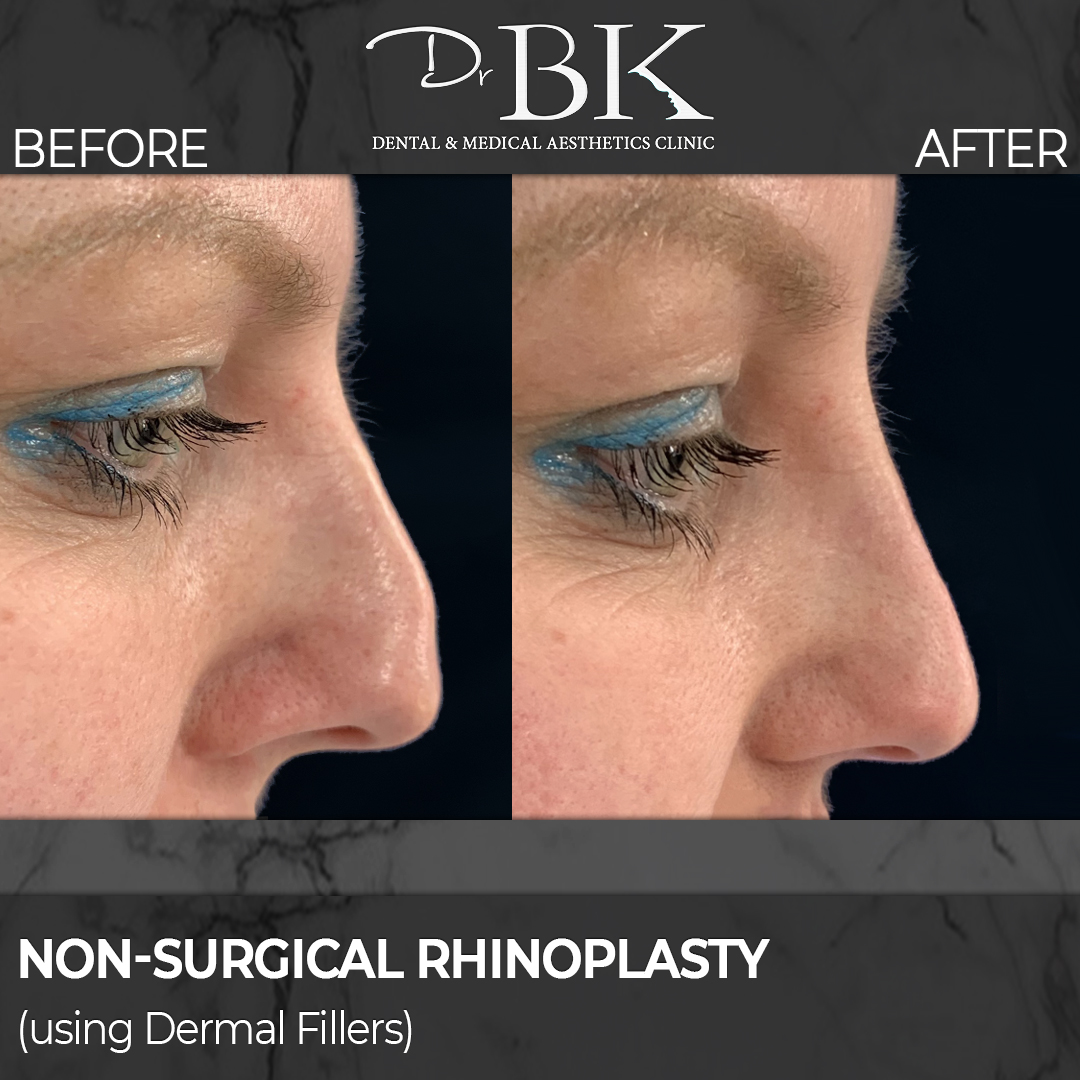 Rhinoplasty-Liene Rhinoplasty-Liene