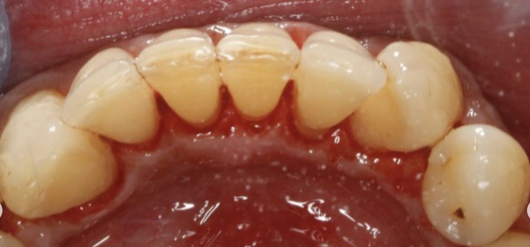 After Hygiene Appointment in Reading (DrBK Reading) Hygiene Appointments in Reading (DrBK Reading)