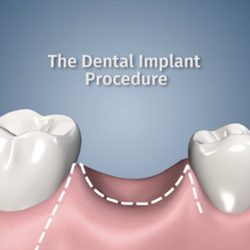 The Dental Implant Process