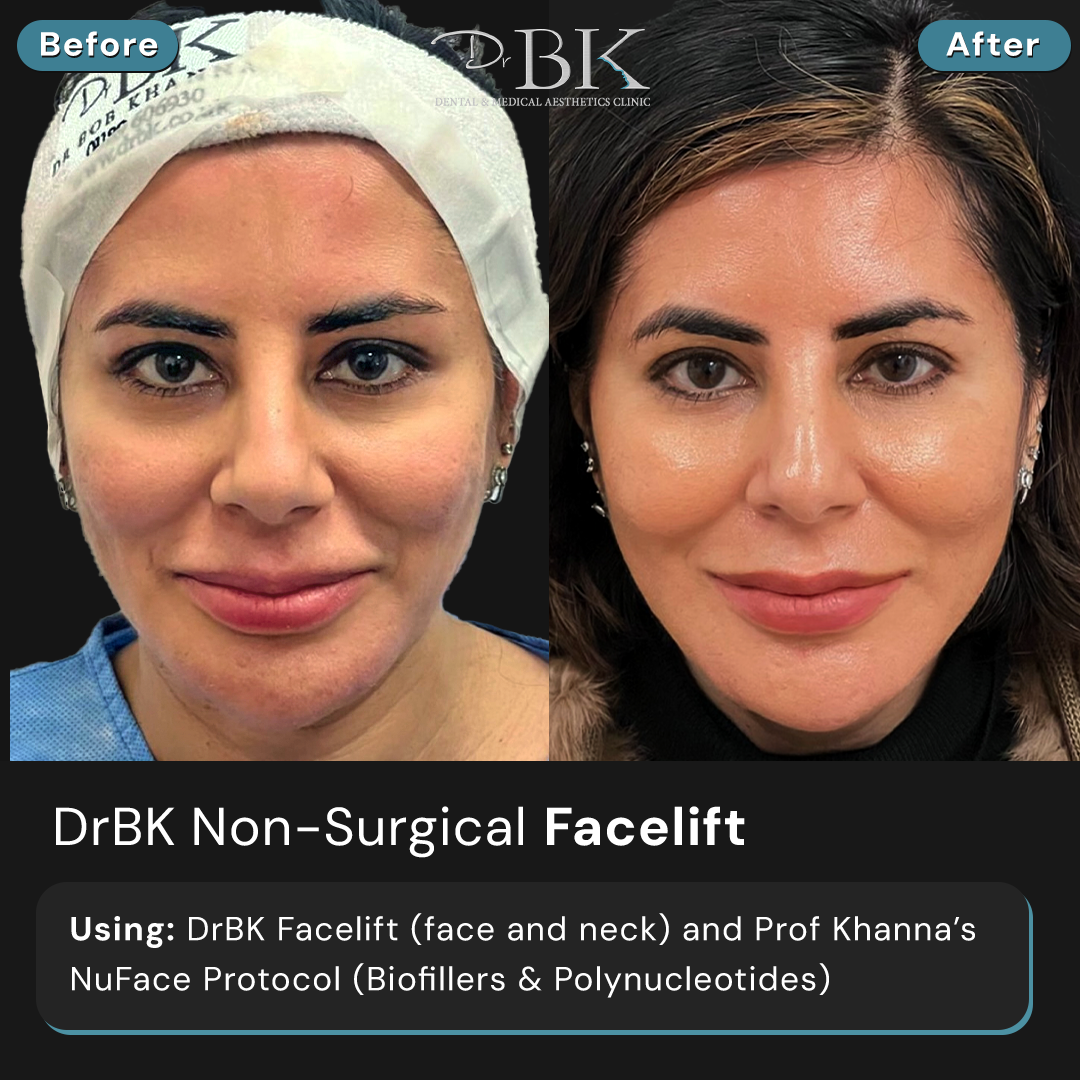 DrBK Facelift (Face & Neck) DrBK Facelift (Face & Neck)