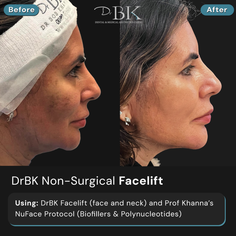 DrBK Facelift (Face & Neck) DrBK Facelift (Face & Neck)