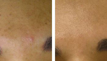 Sun-Damage-Treatment-hydrafacial-beforeandafter