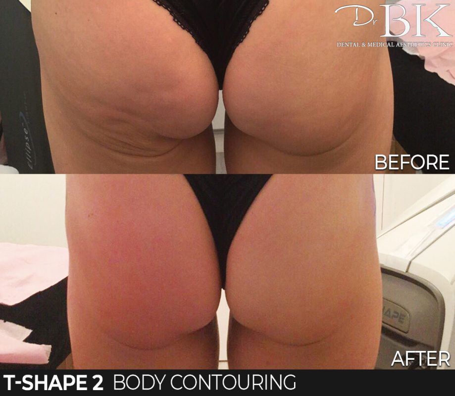 Body Contouring with T-Shape 2