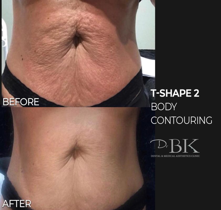 Body Contouring & Skin Tightening with T-Shape 2