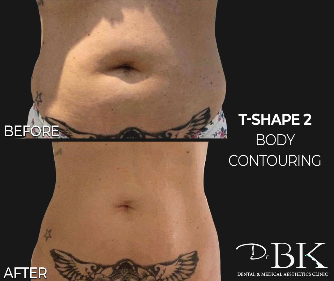 Body Contouring with T-Shape 2