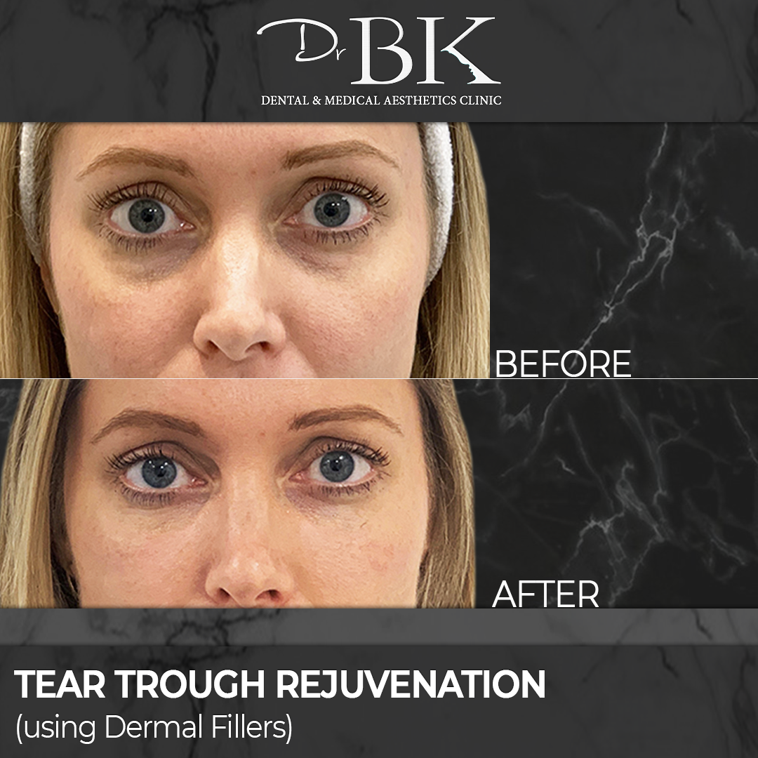 Tear trough rejuvenation - dermal fillers