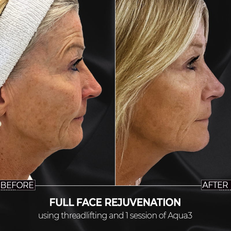 Threadlifting and Aqua3