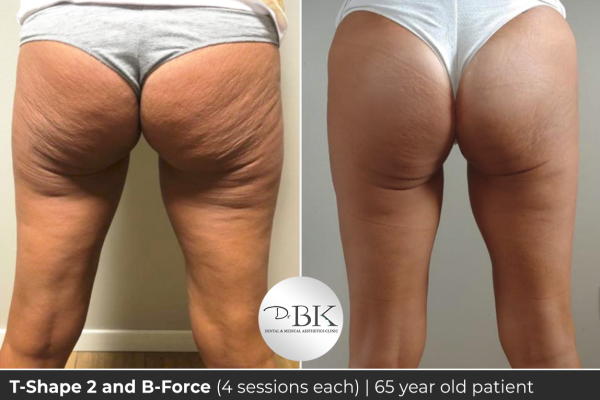 Tshape and bforce - 65 year old copy