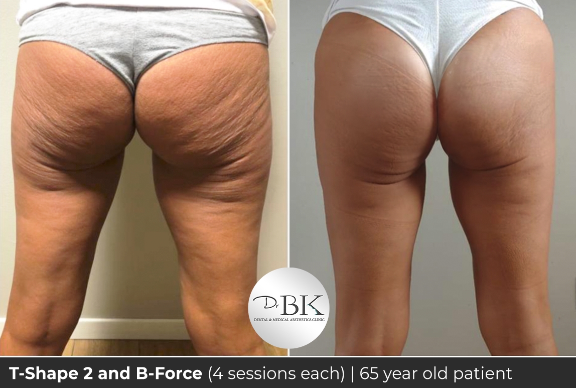 Tshape and bforce - 65 year old copy