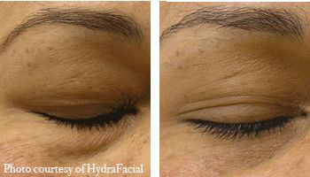 Undereye-Puffiness-Treatment-HydraFacial-Before and after