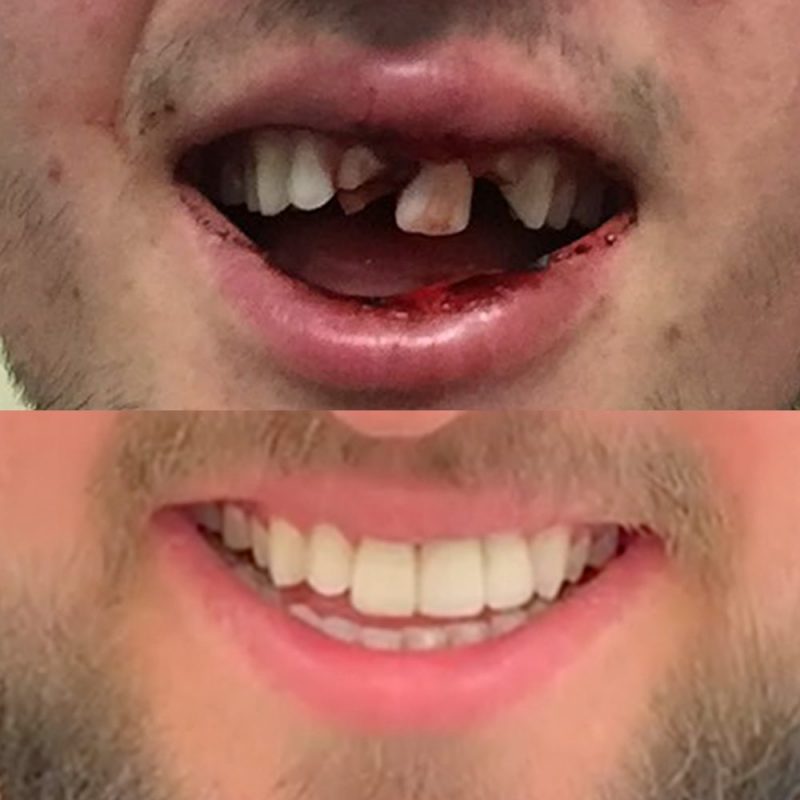 dental implants