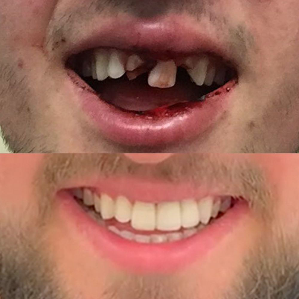 Before & After Treatment