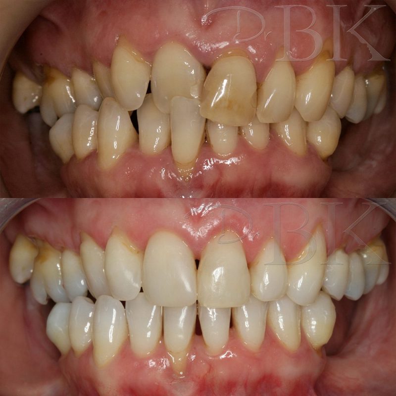 orthodontics clear aligners