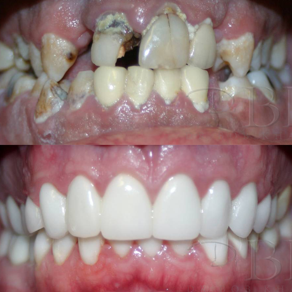 Before & After Full Mouth Rehabilitation