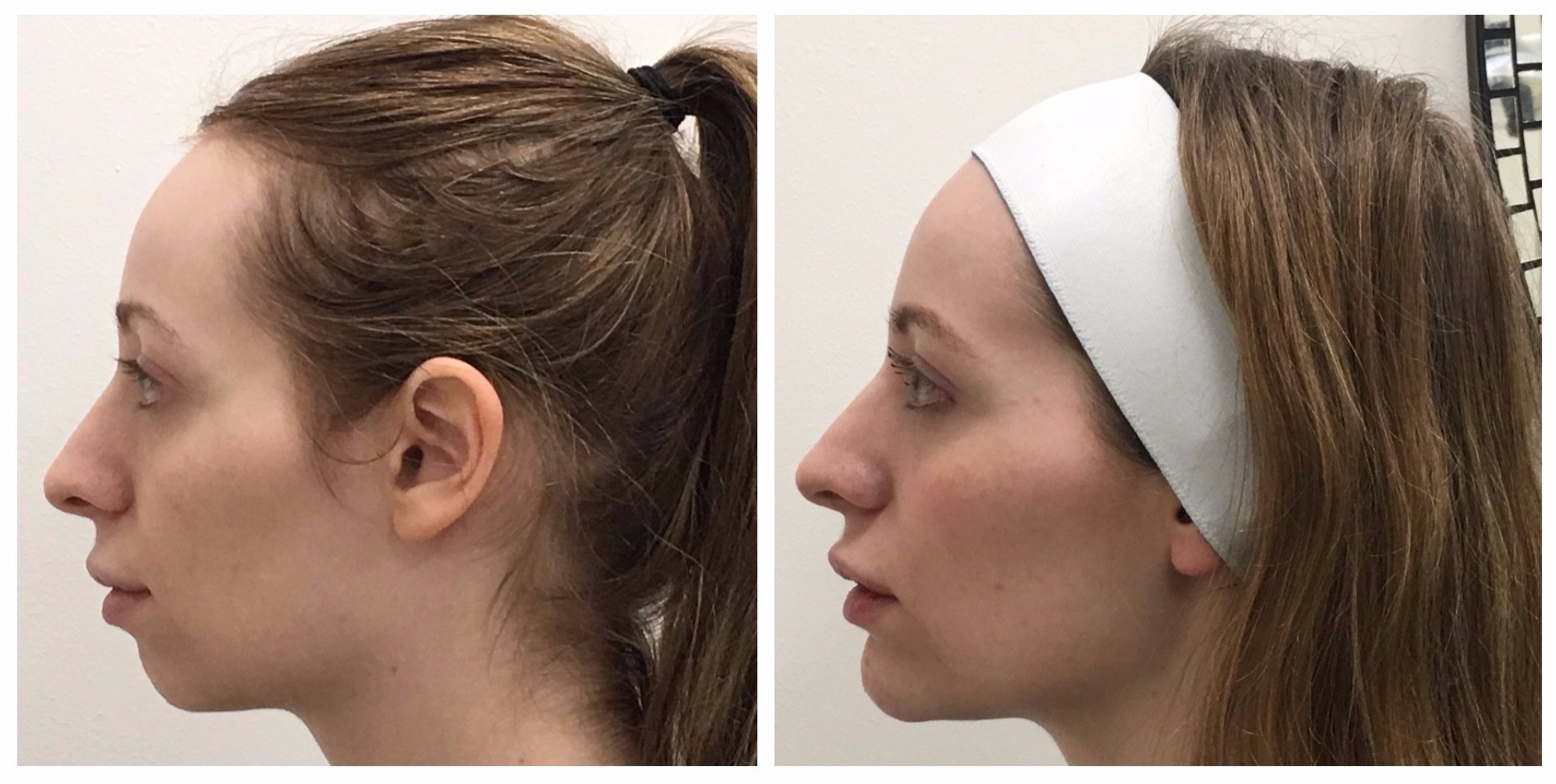 jawline augmentation/fillers - drbk cosmetic dentist