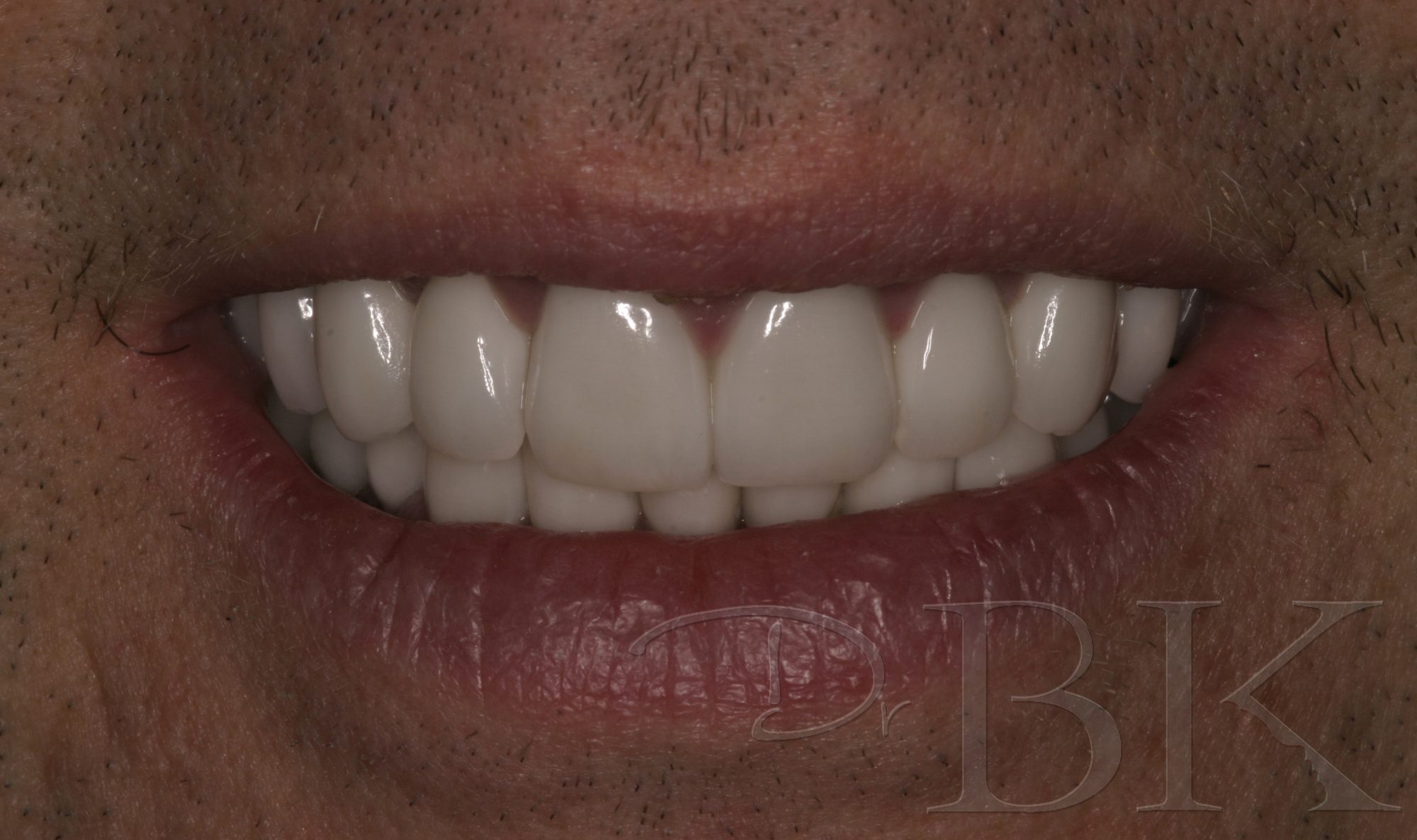 VENEERS PT 3 AFTER copy