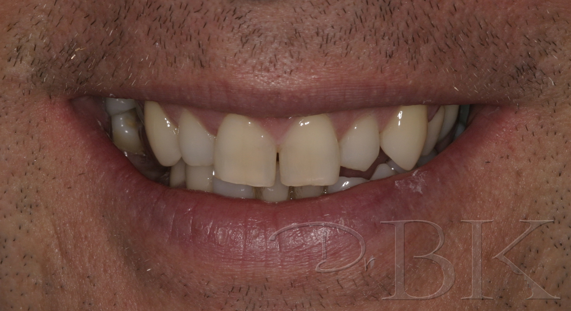 VENEERS PT 3 BEFORE copy