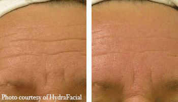 Wrinkles-Reduction-HydraFacial-Before and after