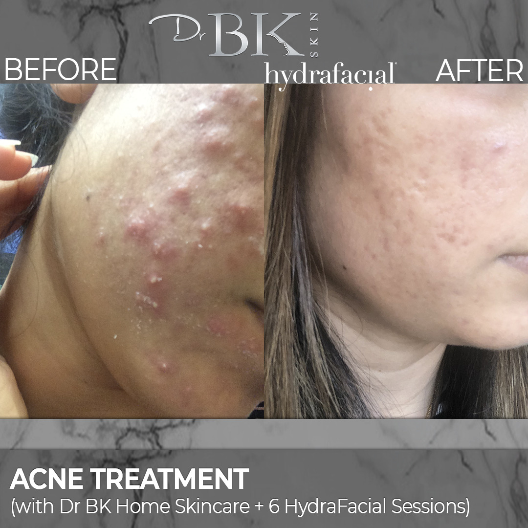 Acne Protocol - HydraFacial