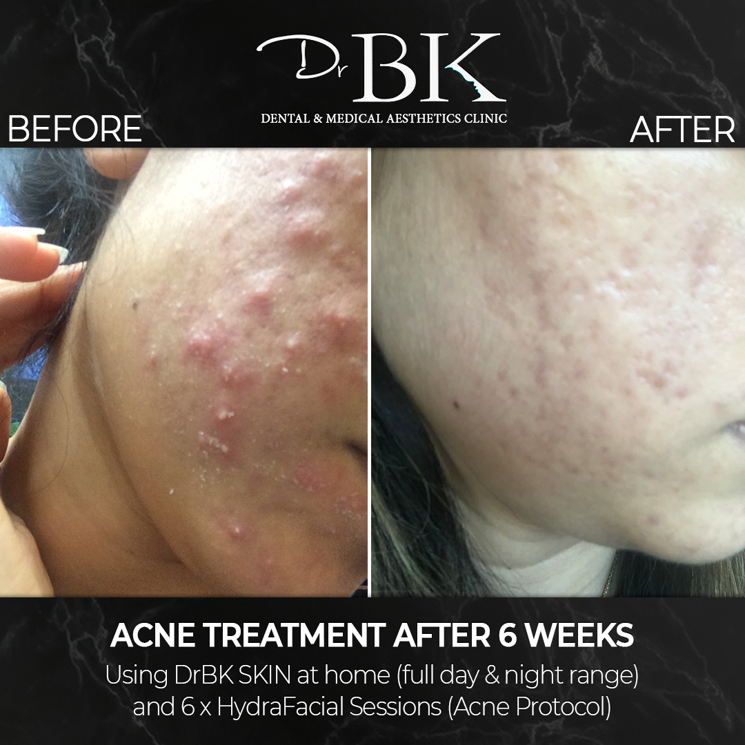 acne-skincare-hydrafacial