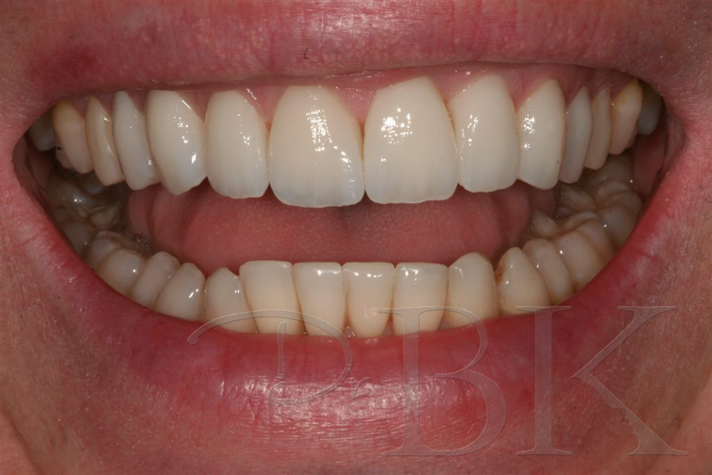 after 3 months of orthodontic treatment and veneers