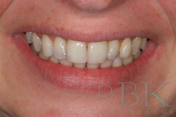12 Weeks After Orthodontic Treatment with Clear Aligners at DrBK Reading