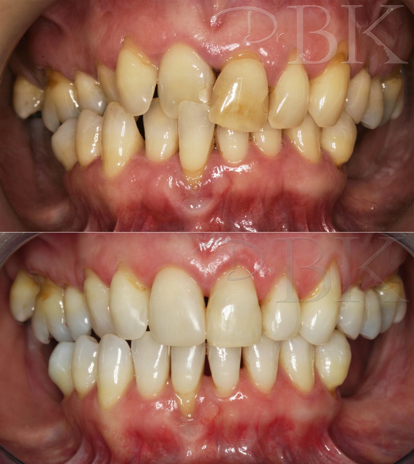 Before and After Full Smile Makeover at DrBK