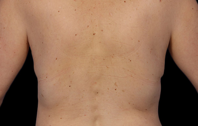 Coolsculpting (Fat Freezing) at DrBK - Before and After Transformation