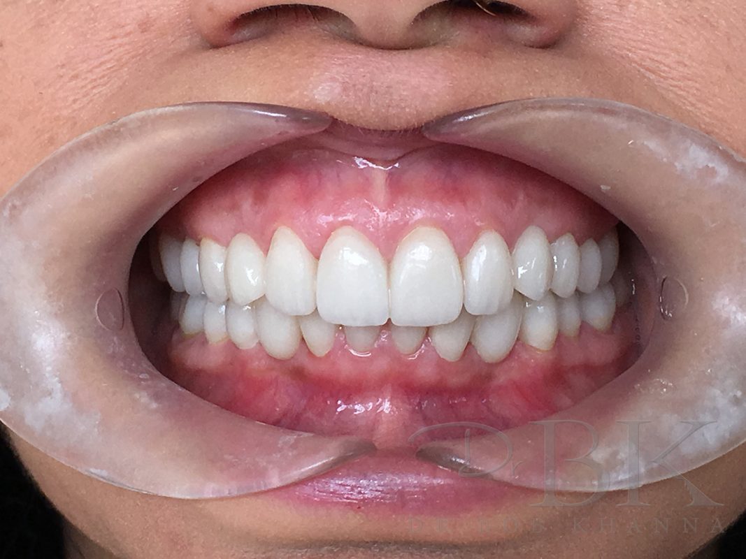 Dental Veneers Veneers Reading Veneers London DrBK