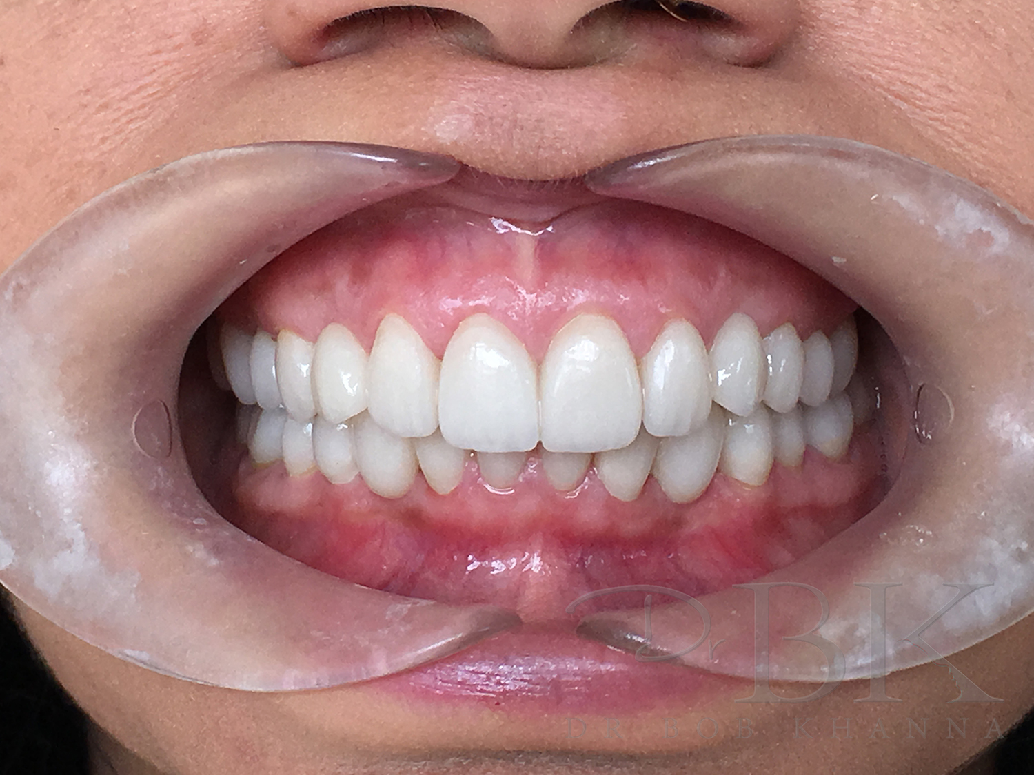 Dental Veneers Veneers Reading Veneers London DrBK