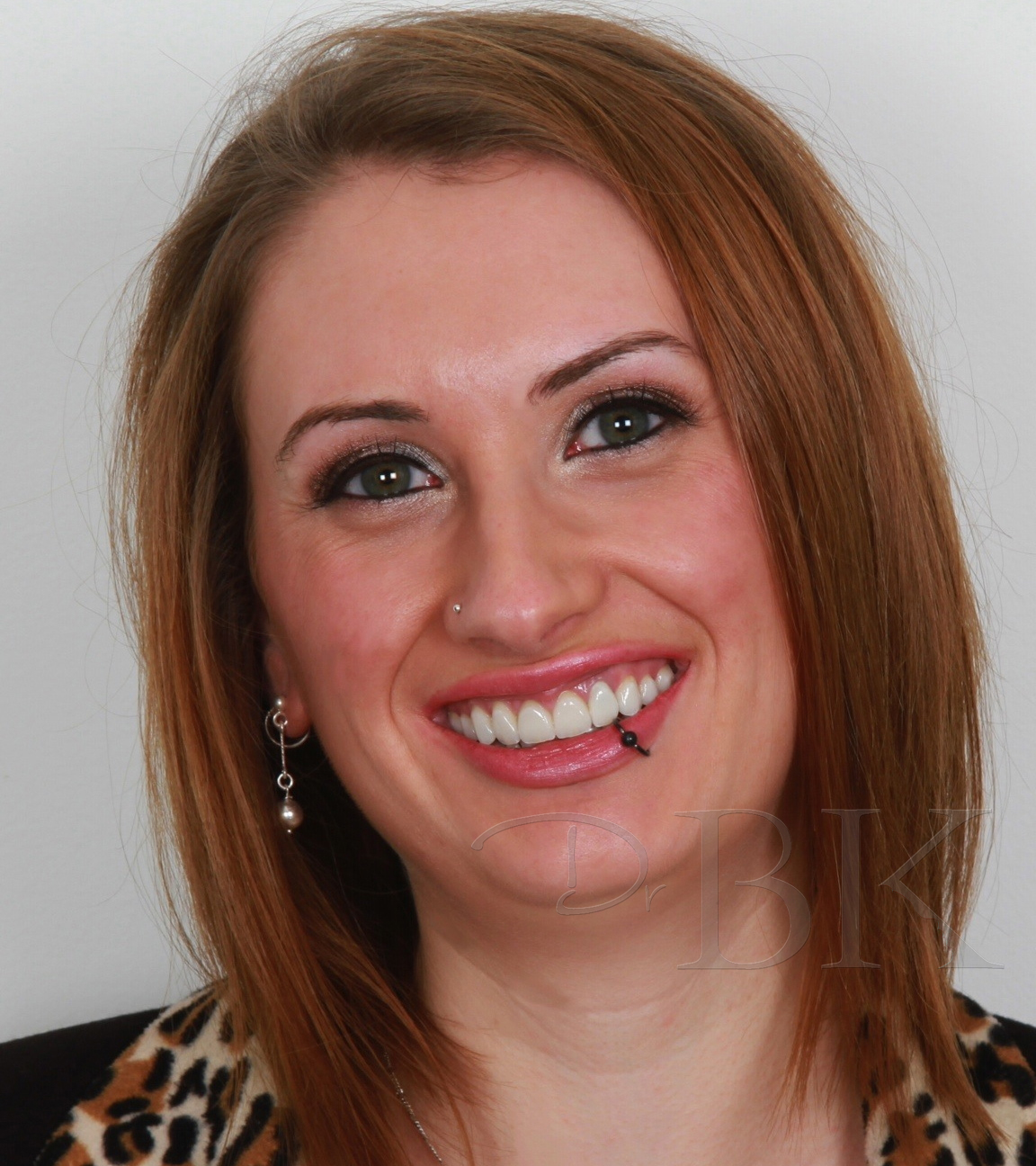 After Full Smile Makeover at DrBK After Full Smile Makeover at DrBK