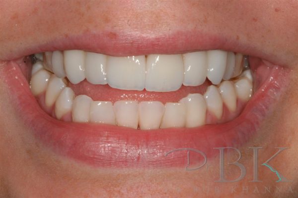 after orthontic treatment and veneers