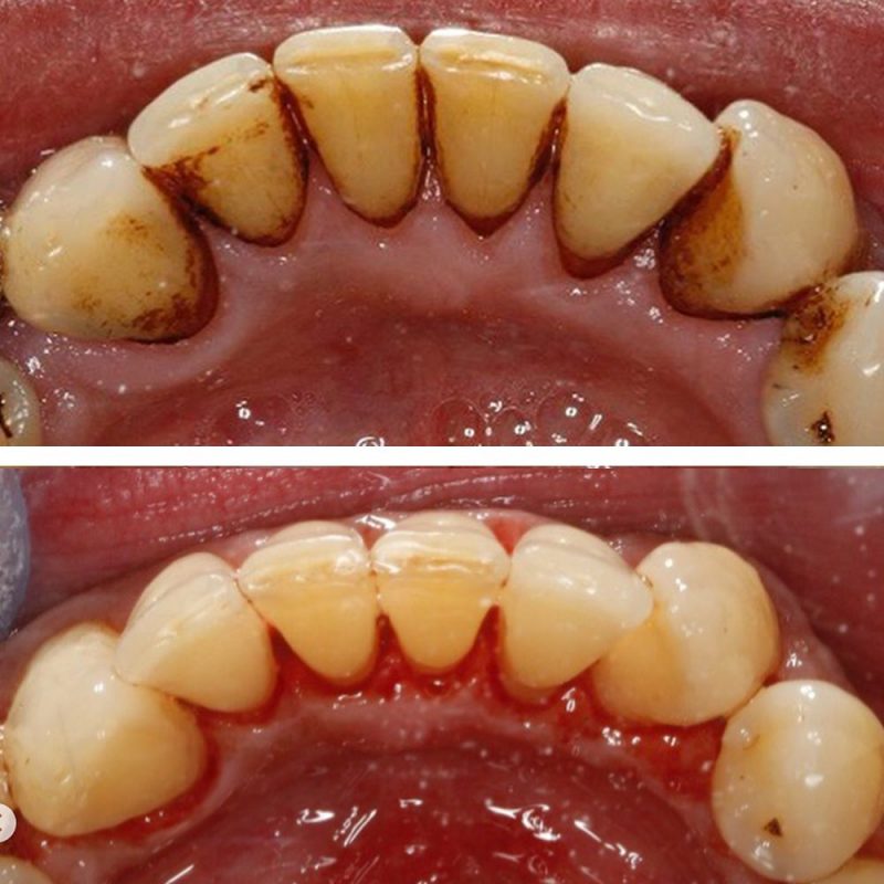 airflow dental hygiene drbk before and after airflow dental hygiene at drbk
