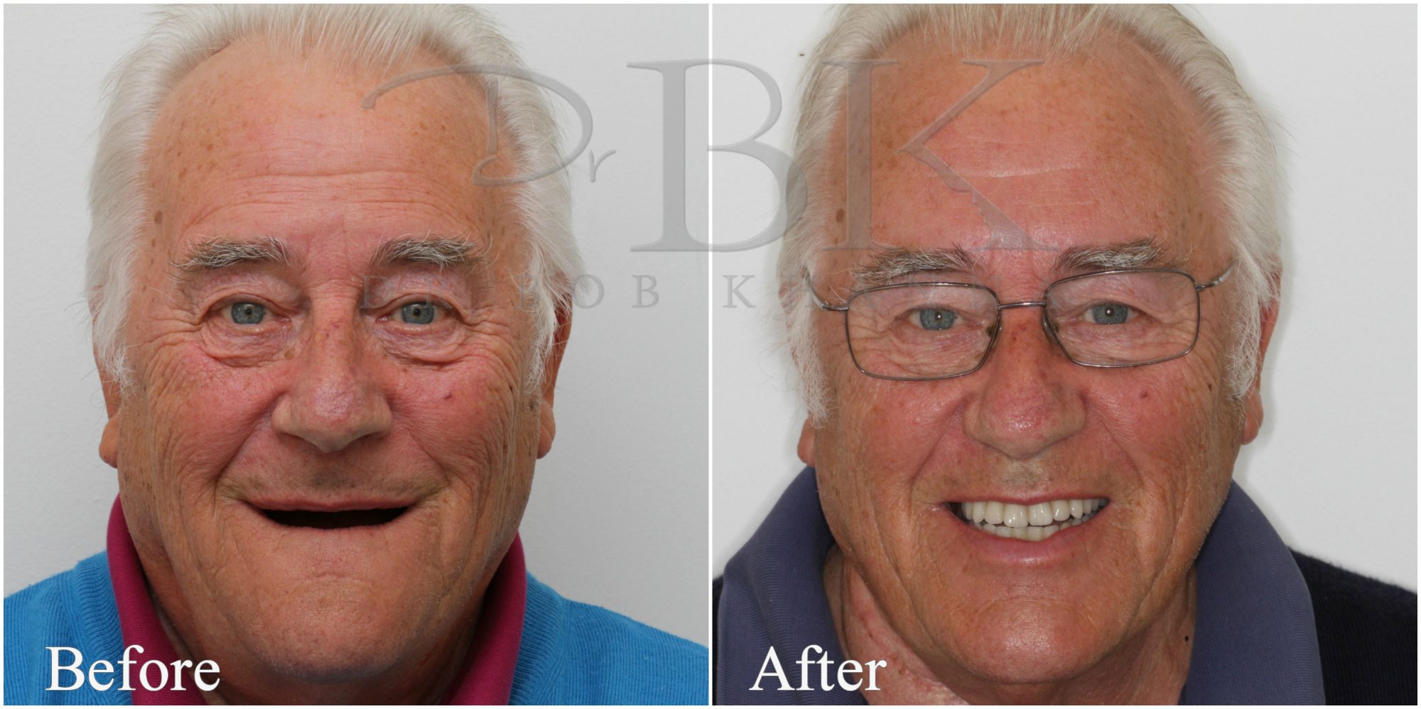 Before & After Dental Implants Before & After Dental Implants