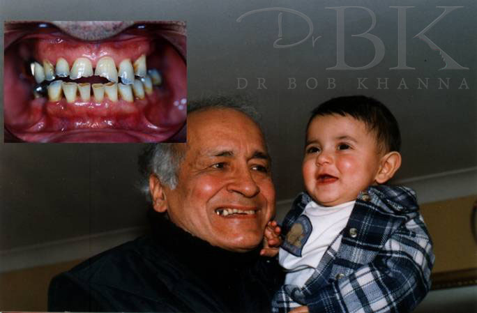 Before Dental Implants Before Dental Implants