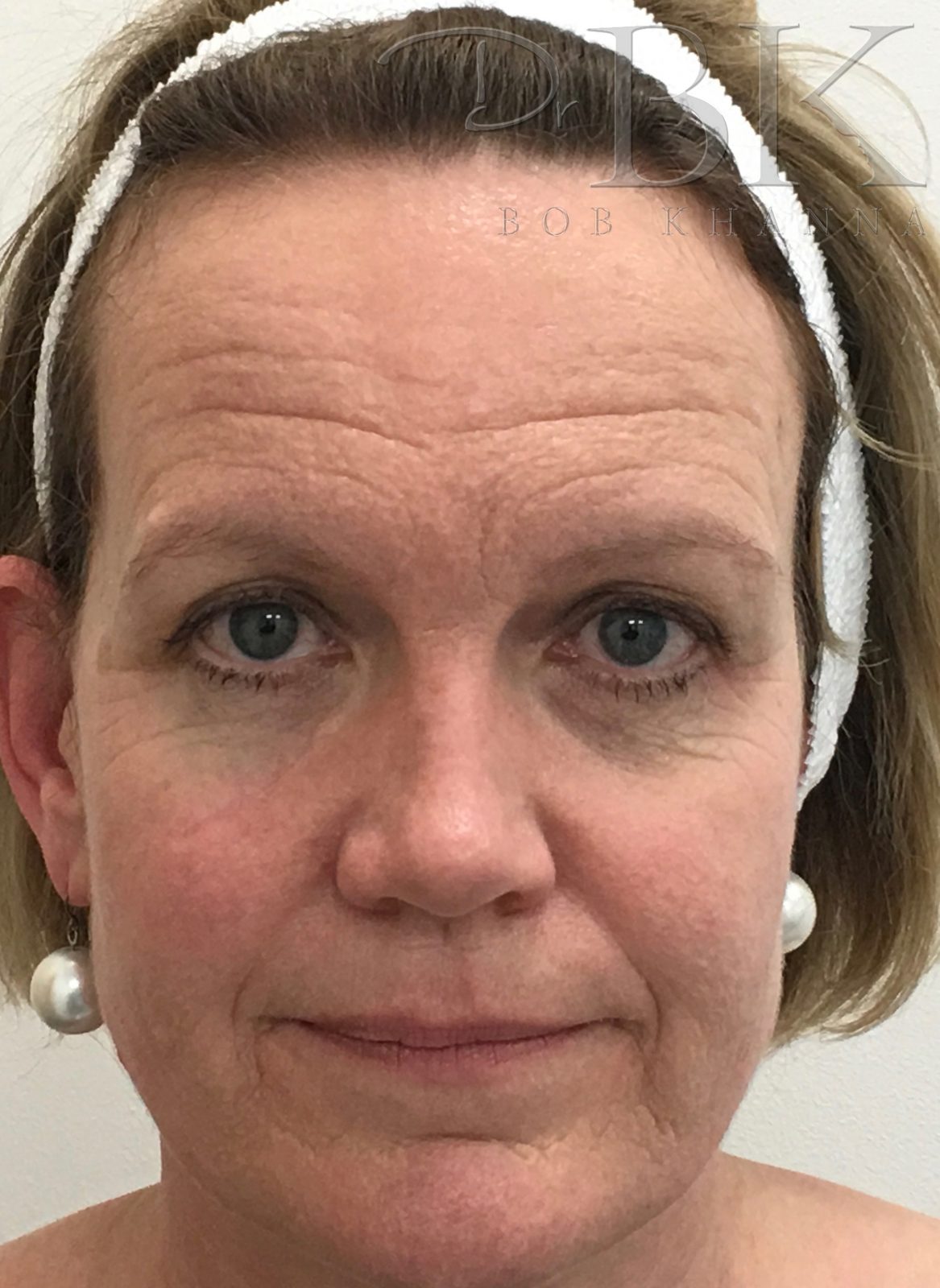 anti wrinkle BEFORE