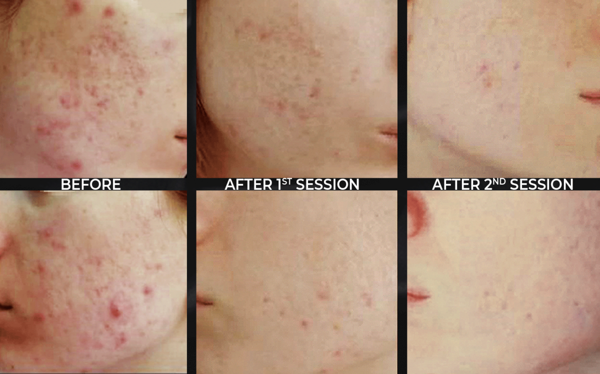 Aqua3 - Mesotherapy for acne, stretch marks, skin rejuvenation and more Aqua3 - Mesotherapy for acne, stretch marks, skin rejuvenation and more