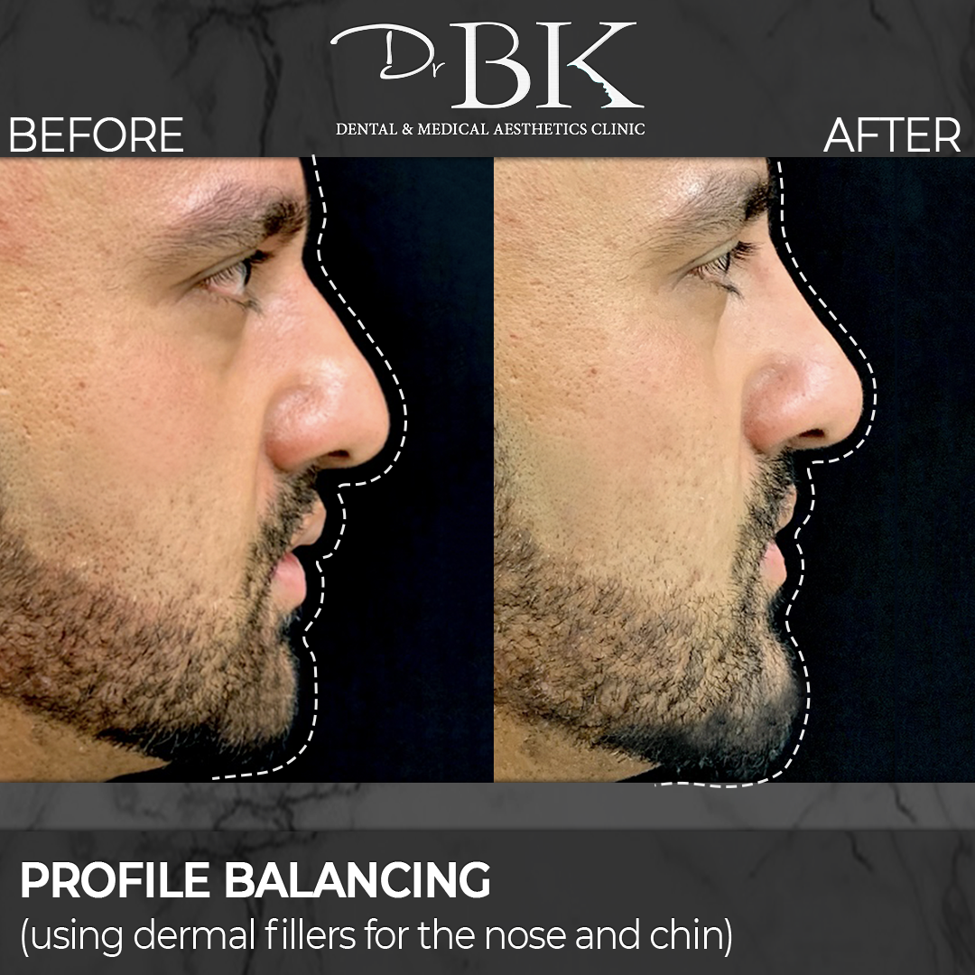 Chin Filler Chin Augmentation at DrBK Clinic in Reading