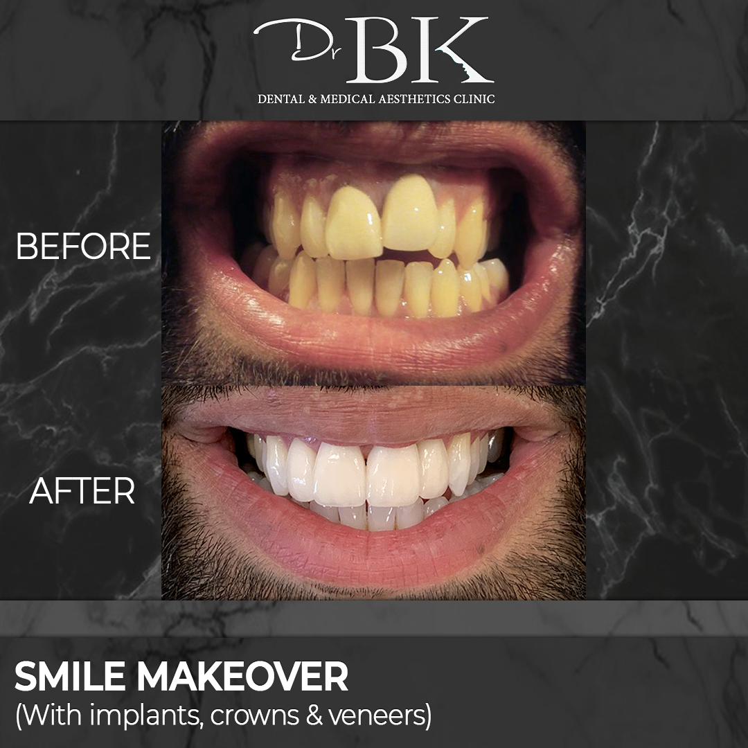 (Treatments included: Implants, veneers, crowns, whitening)