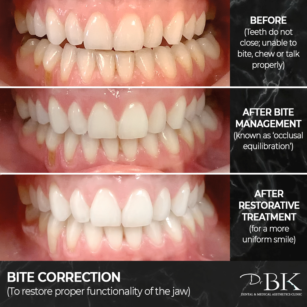 Before and after bite management treatment at DrBK Clinic