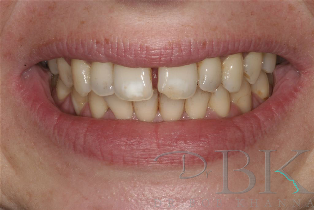 Before Orthodontic Treatment with Clear Aligners at DrBK Reading