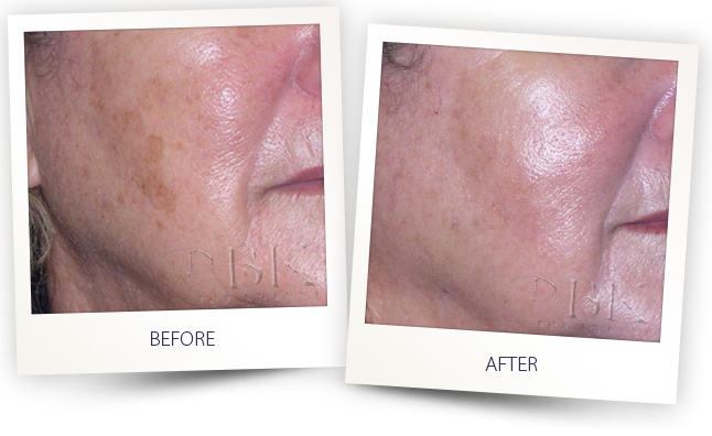 pigmentation treatment drbk