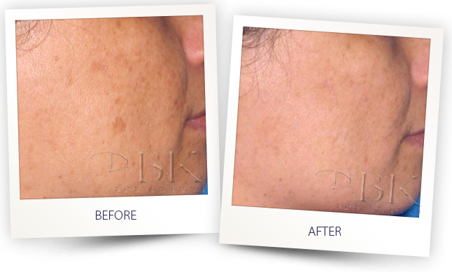 Harmony AFT IPL Treatment Harmony AFT IPL Treatment