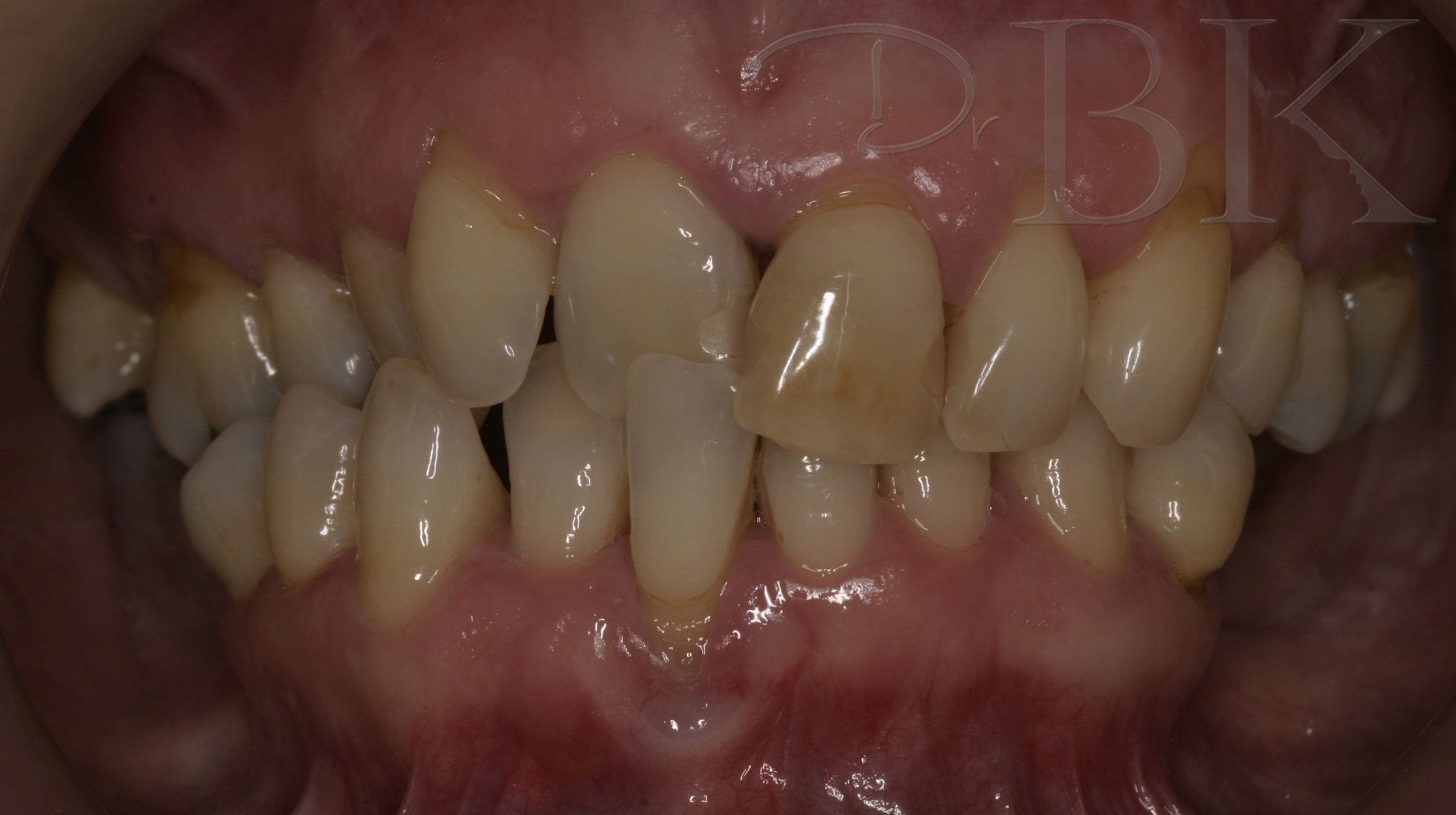 Before Orthodontic Treatment with Clear Aligners at DrBK Reading