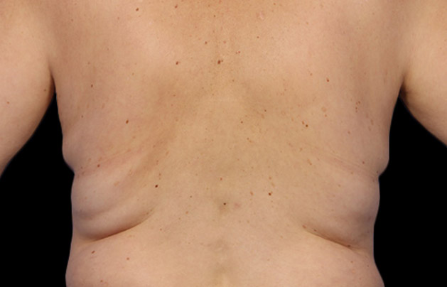 Coolsculpting (Fat Freezing) at DrBK - Before and After Transformation
